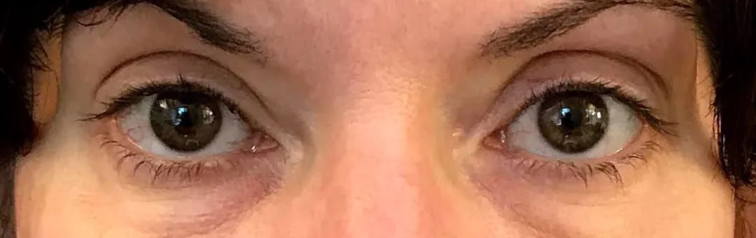 Before — Botox Brow Lift, actual patient of Dr. John J.W. Lee