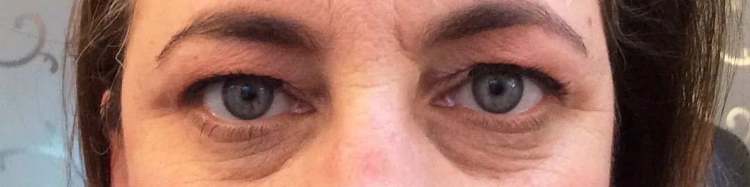 Before — Botox Brow Lift, actual patient of Dr. John J.W. Lee