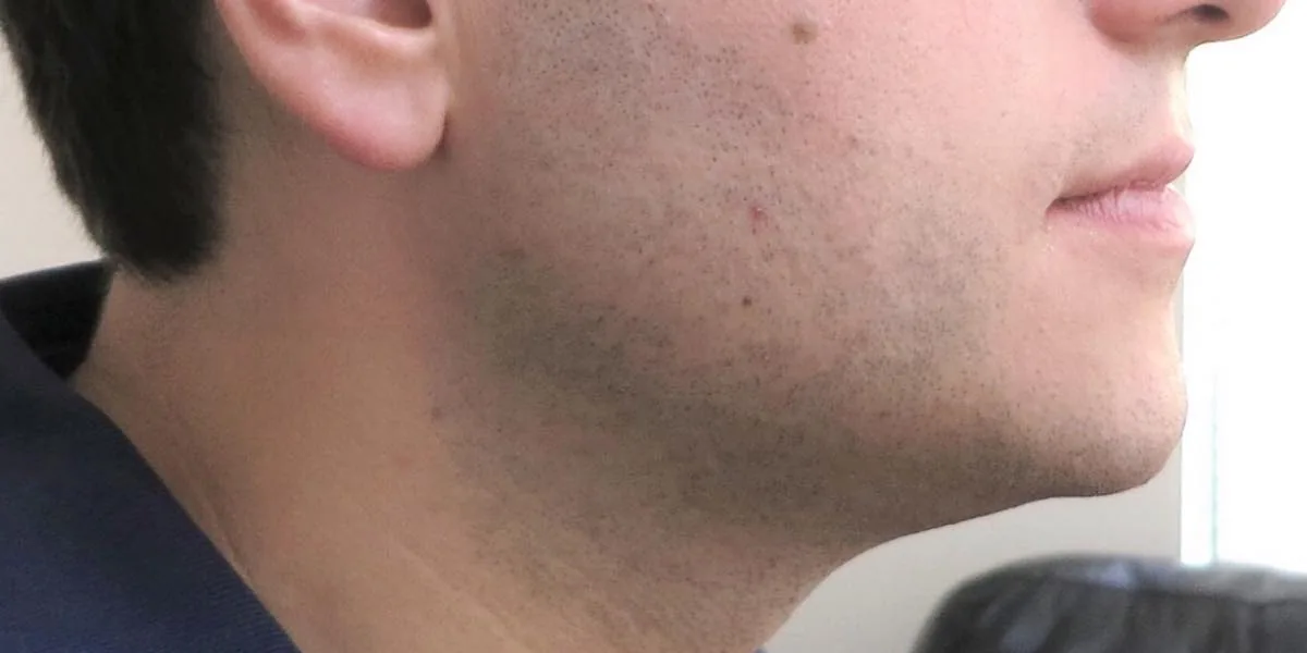 After — Kybella, actual patient of Dr. John J.W. Lee