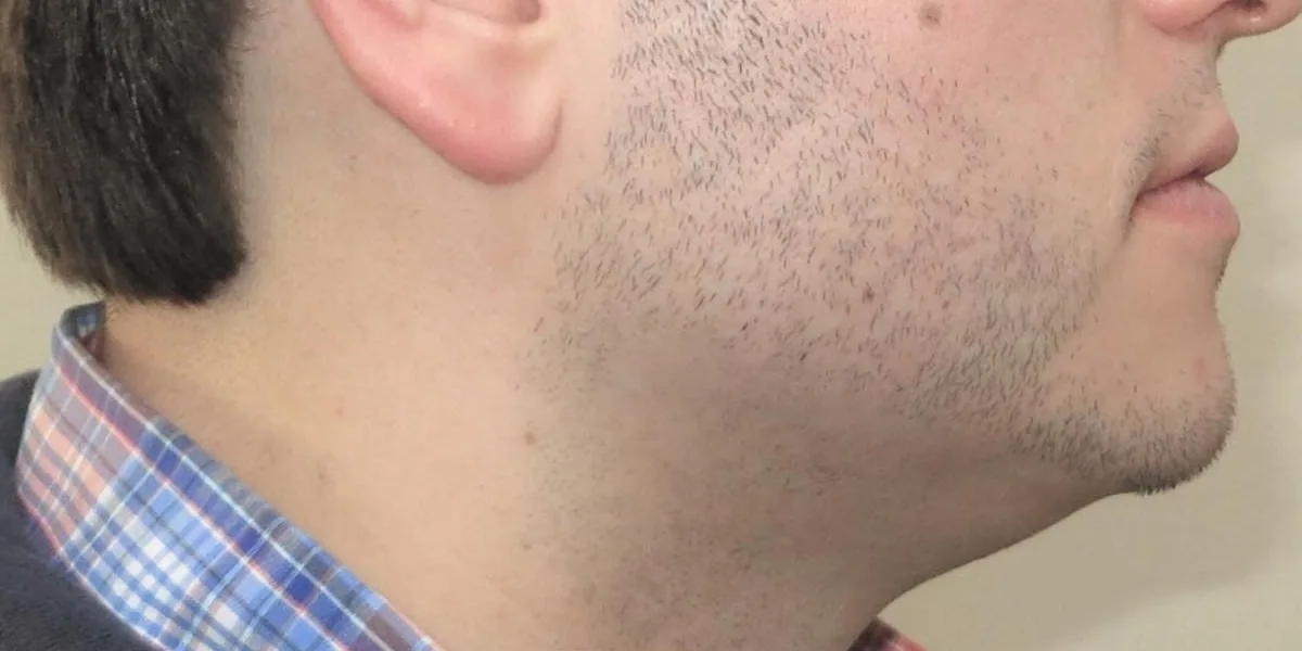 Before — Kybella, actual patient of Dr. John J.W. Lee