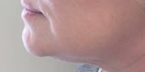 After — Kybella, actual patient of Dr. John J.W. Lee