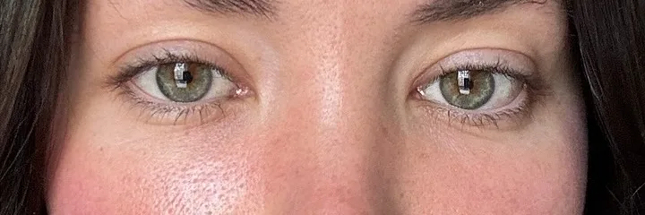 After — Lower Eyelid Surgery, actual patient of Dr. John J.W. Lee