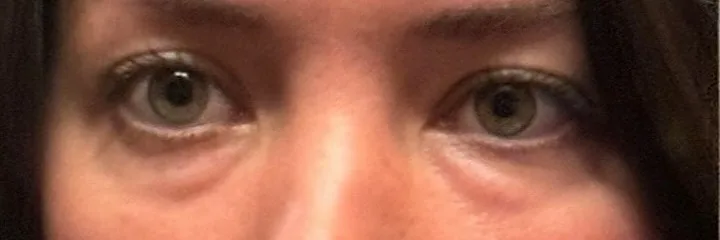 Before — Lower Eyelid Surgery, actual patient of Dr. John J.W. Lee