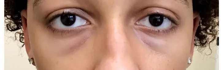 Before — Lower Eyelid Surgery, actual patient of Dr. John J.W. Lee