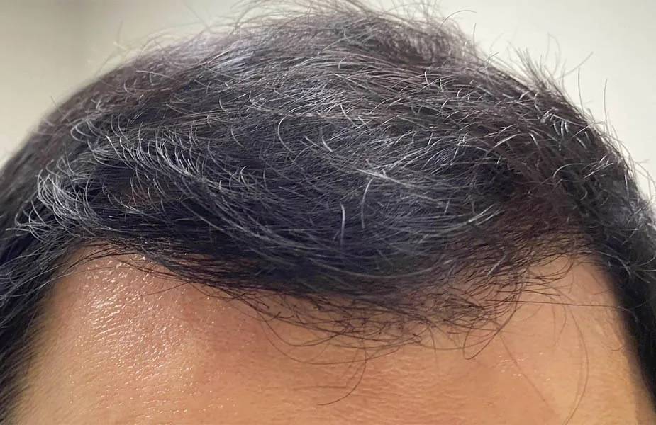 After — NeoGraft Hair Restoration, actual patient of Dr. John J.W. Lee