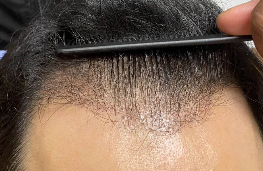 Before — NeoGraft Hair Restoration, actual patient of Dr. John J.W. Lee
