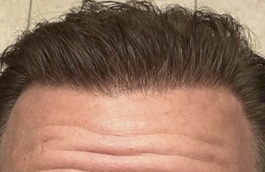 After — NeoGraft Hair Restoration, actual patient of Dr. John J.W. Lee