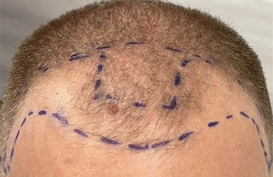 Before — NeoGraft Hair Restoration, actual patient of Dr. John J.W. Lee