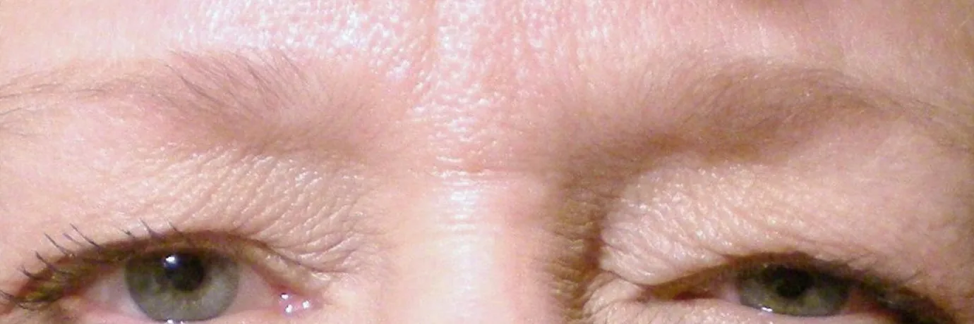 Before — Ptosis Repair, actual patient of Dr. John J.W. Lee