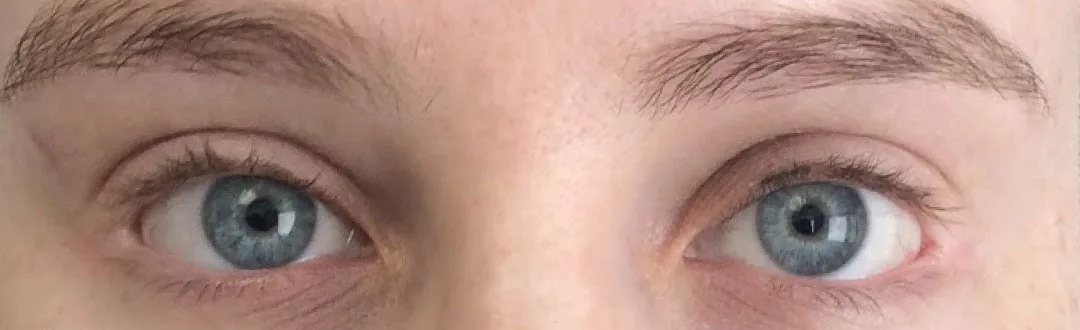 After — Ptosis Repair, actual patient of Dr. John J.W. Lee
