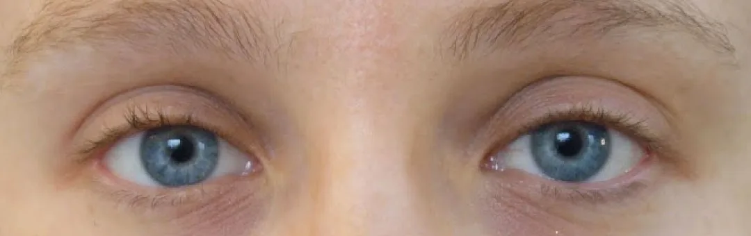 Before — Ptosis Repair, actual patient of Dr. John J.W. Lee