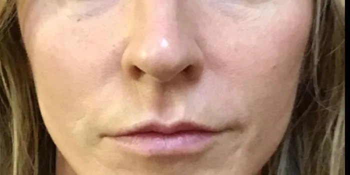 After — Temple Mid Facelift, actual patient of Dr. John J.W. Lee