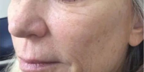 After — Temple Mid Facelift, actual patient of Dr. John J.W. Lee