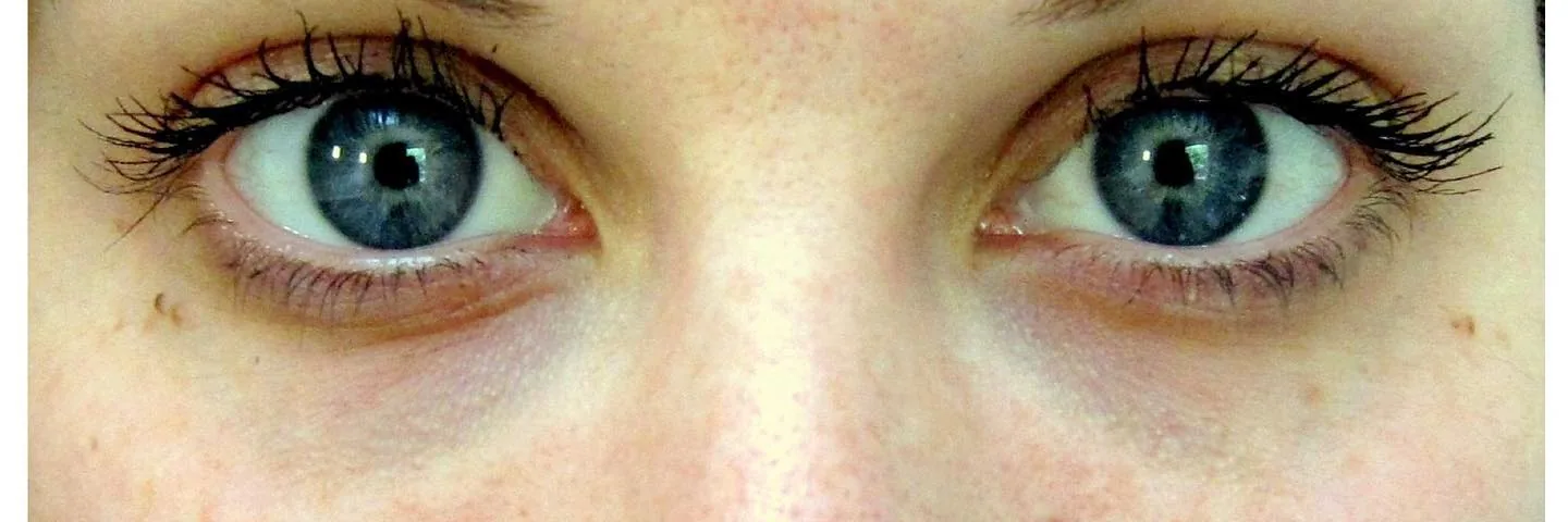 After — Facial Fillers, actual patient of Dr. John J.W. Lee
