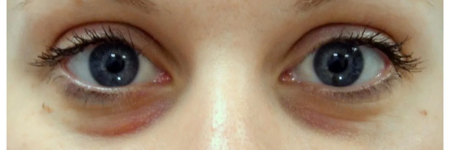 Before — Facial Fillers, actual patient of Dr. John J.W. Lee
