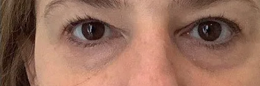 Before — Facial Fillers, actual patient of Dr. John J.W. Lee