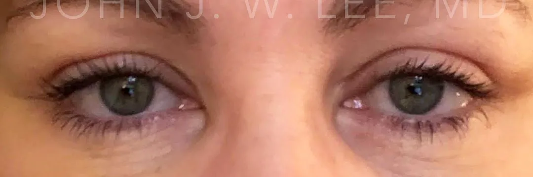 After — Upper Eyelid Surgery, actual patient of Dr. John J.W. Lee