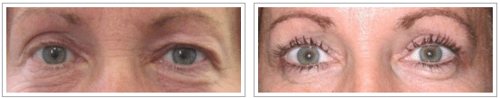 before and after upper eyelid surgery procedure