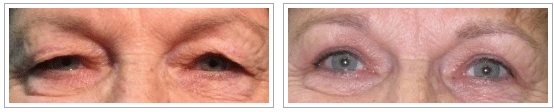 before and after upper eyelid surgery procedure