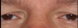 Upper Eyelid Blepharoplasty case #10881