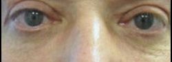 Lower Eyelid Blepharoplasty case #10818