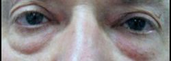 Lower Eyelid Blepharoplasty case #10818