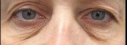 Lower Eyelid Blepharoplasty case #10793