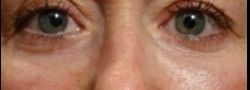 Lower Eyelid Blepharoplasty case #10790