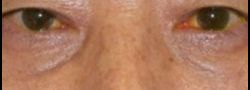 Lower Eyelid Blepharoplasty case #10730