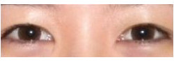 Asian Crease & Double Eyelid Surgery case #10637